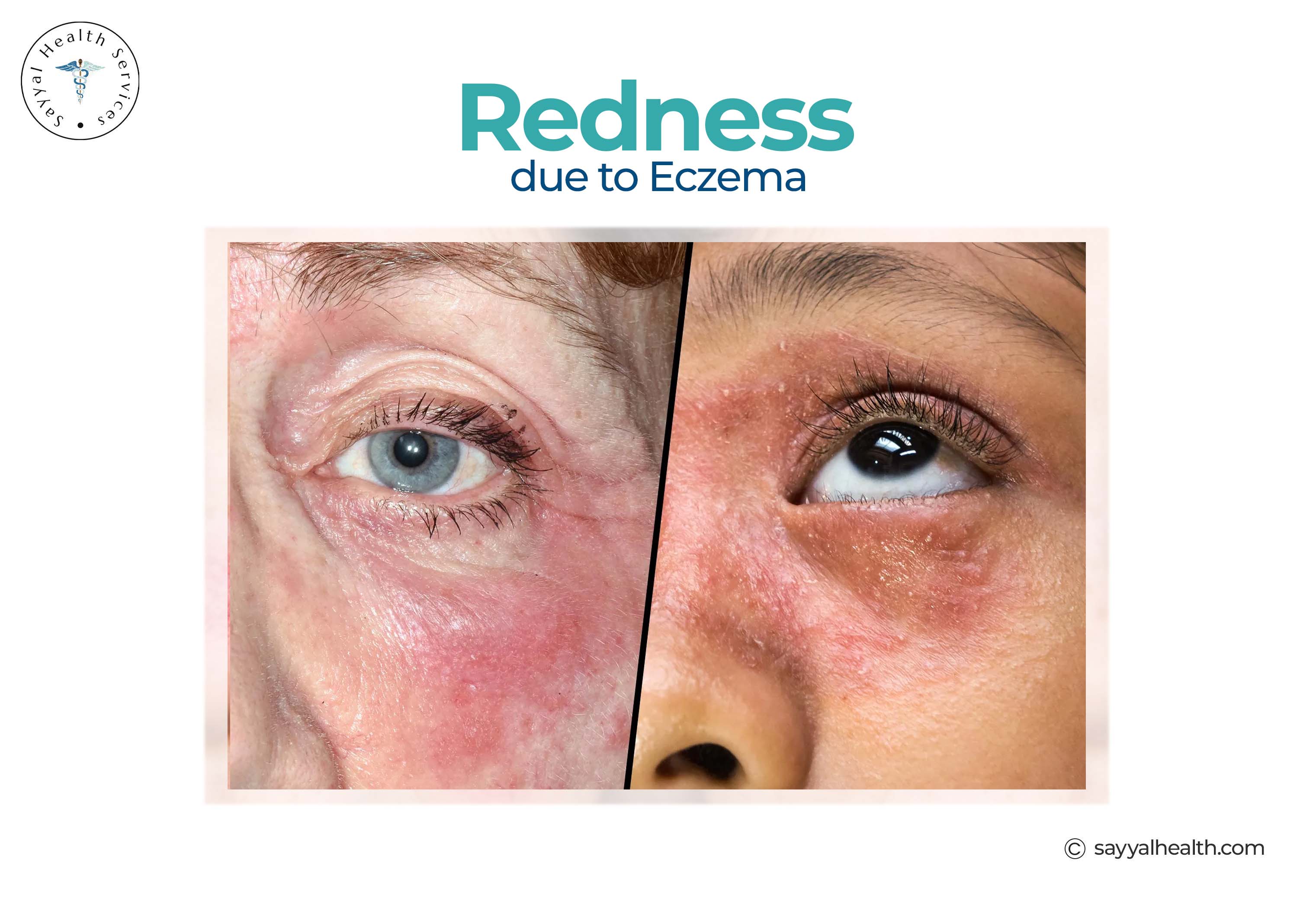 Facial redness and inflammation caused by eczema around eyes